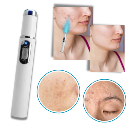 GlowRenew | Laserpen